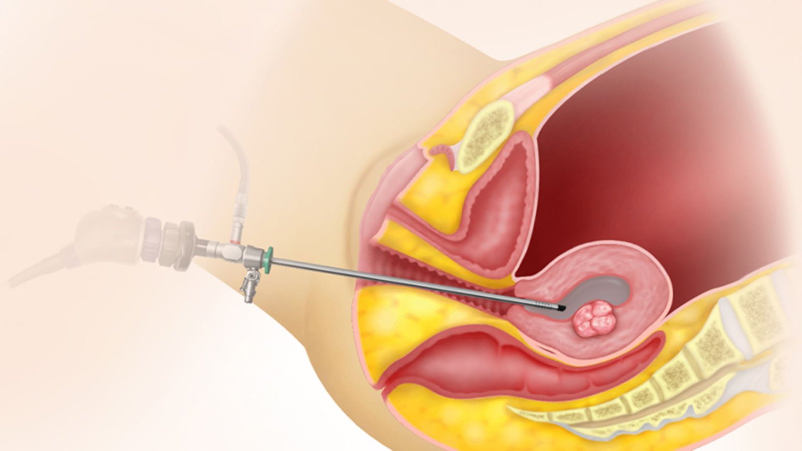 Hysteroscopy — Same Day Uterine Surgery