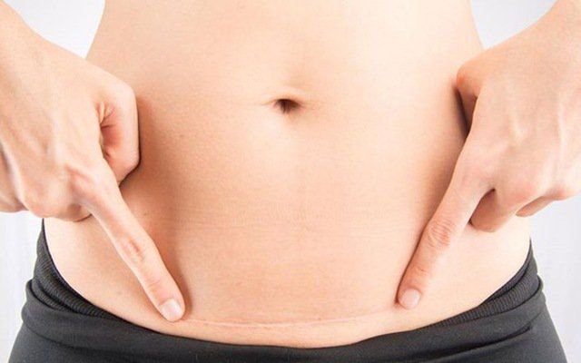 Laser Caesarean Section and Normal Delivery — Stitchless Surgery