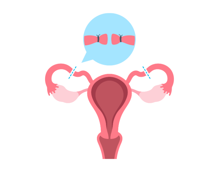Tubal Ligation — Permanent Female Sterilisation